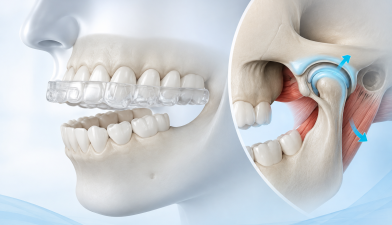 tmj splint therapy for jaw pain