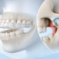 tmj splint therapy nepal 85x85